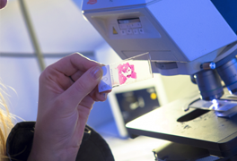 cellules-tumorales-pulmonaires-cancer-poumon-Chaire-de-Pneumologie-Expérimentale-Fondation-Université-Limoges